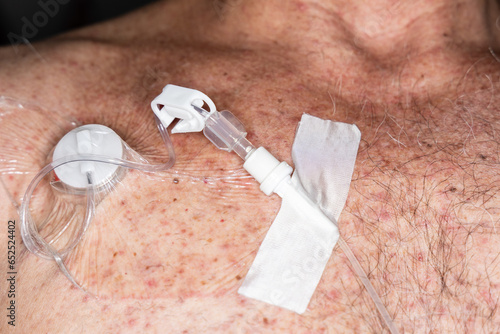 Tube for intravenous fluids injections to implantable port for chemotherapy