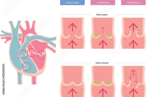 心臓弁膜症の図解／Diagram of heart valve disease photo