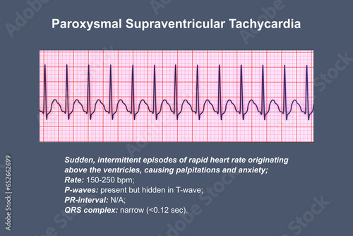 фотографія ECG in supraventricular tachycardia, 3D illustration