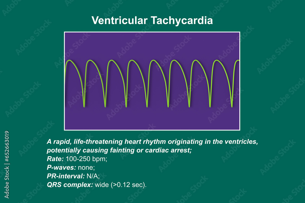 ECG in ventricular tachycardia, 3D illustration.