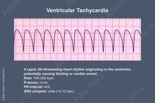 ECG in ventricular tachycardia, 3D illustration. photo