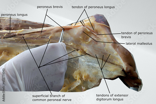 anatomy of lateral compartment of leg i.e. peroneal compartment. contains related muscles, tendon, bony prominence and nerve photo