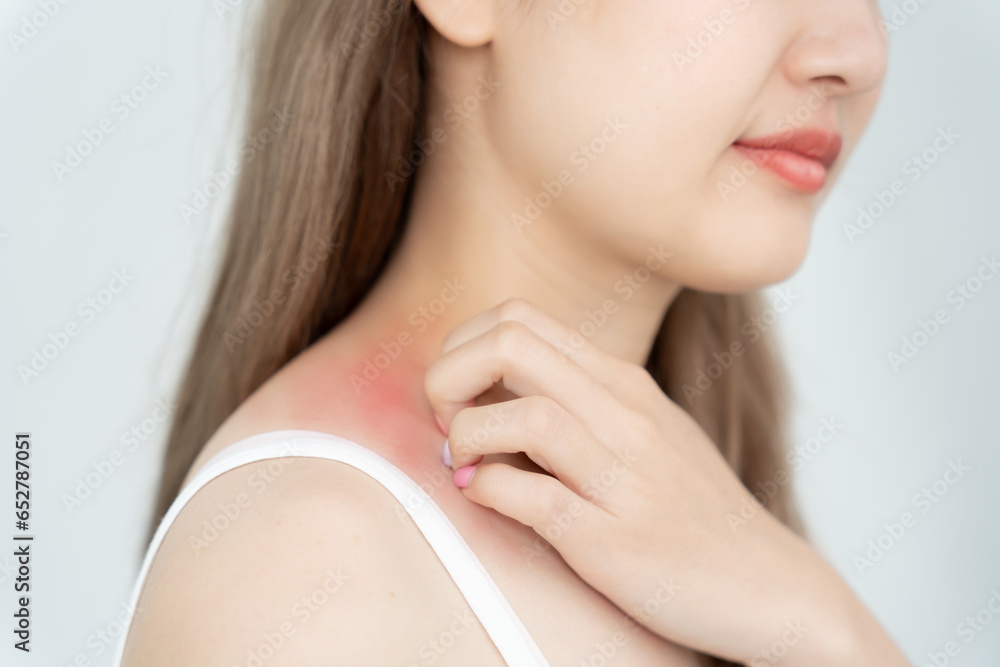 skin problem and beauty. Young woman scratch body has itchy skin from skin allergic, steroid allergy, sensitive skin, red from sunburn, chemical allergy, rash, insect bites, Seborrheic Dermatitis. skin problem and beauty. Young woman scratch body has itchy skin from skin allergic, steroid allergy, sensitive skin, red from sunburn, chemical allergy, rash, insect bites, Seborrheic Dermatitis.