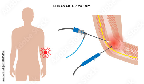 Elbow arthroscopy surgery