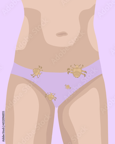 Vector isolated illustration of female pubic lice. Contact with a person with pubic lice.