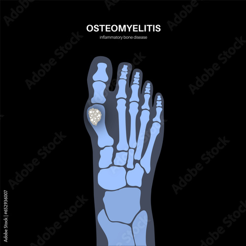 Osteomyelitis of feet photo