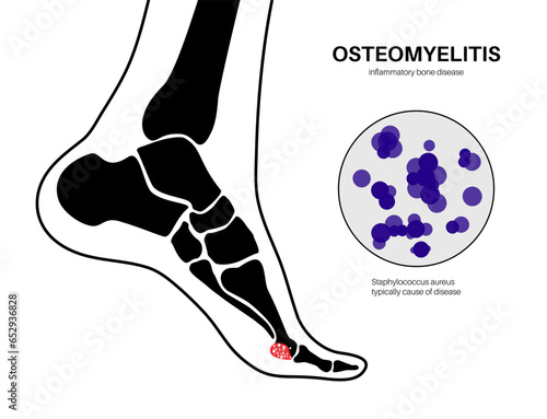 Osteomyelitis of feet