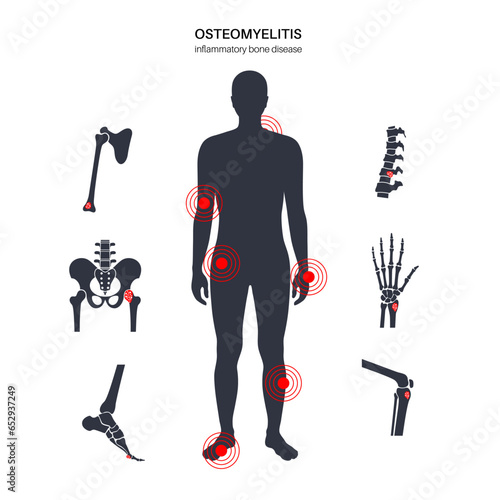 Osteomyelitis disease poster