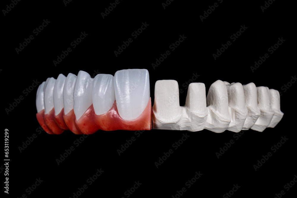 max natural look crowns on implants max natural look crowns on implants
