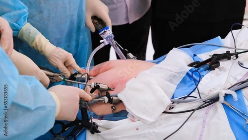 The surgeon does endoscopic surgery on the abdomen. The doctor performs arthroscopic surgery on the abdominal cavity in the operating room with arthroscopic instruments. 