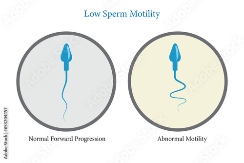 low sperm motility