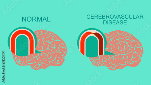Cerebrovascular disease flat vector stock illustration