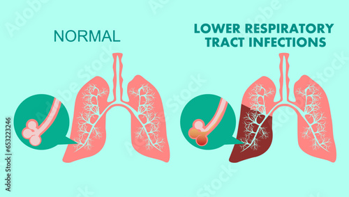 Lower respiratory tract infections, flat vector stock illustration