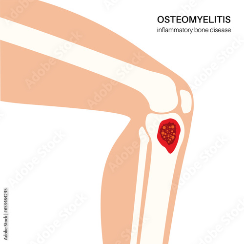 Tibia bone osteomyelitis