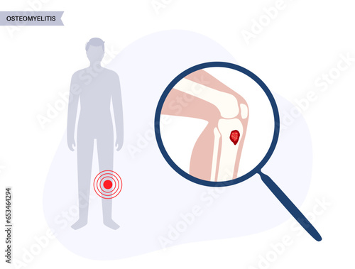 Tibia bone osteomyelitis