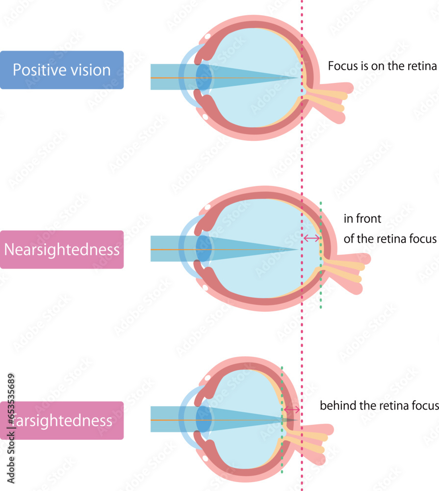 Φωτογραφία 正視、近視、遠視の違いの図解／Illustration of the difference between emmetropia, nearsightednes