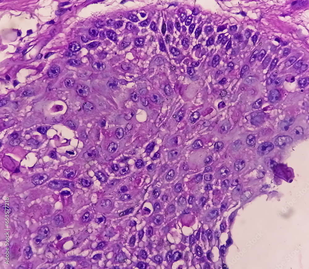 Photomicrograph of Invasive squamous cell carcinoma of the nipple, Grade-II