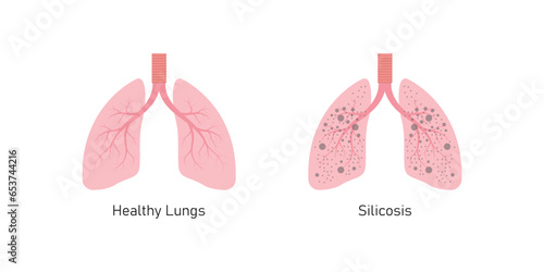 Silicosis Pulmonary Fibrosis Concept Design. Vector Illustration.