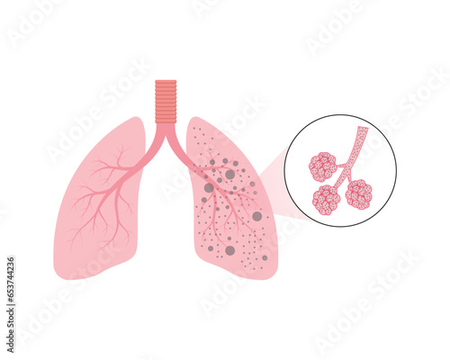 Silicosis Pulmonary Fibrosis Concept Design. Vector Illustration.