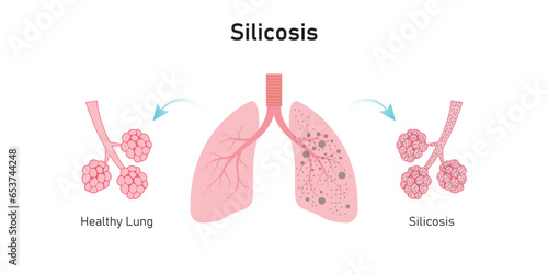 Silicosis Pulmonary Fibrosis Concept Design. Vector Illustration.