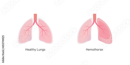 Hemothorax Lung Disease Concept Design. Vector Illustration.