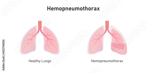 Hemopneumothorax Lung Disease Concept Design. Vector Illustration.