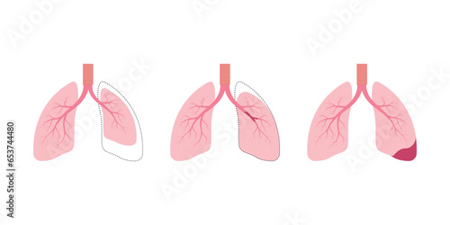 Atelectasis Lung Disease Concept Design. Vector Illustration. photo
