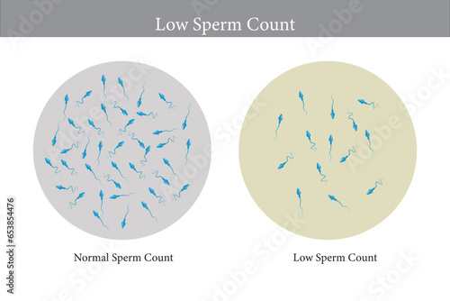 normal and low sperm count illustration. Male infertility oligospermia. Structure of the sperm. Vector. eps 10