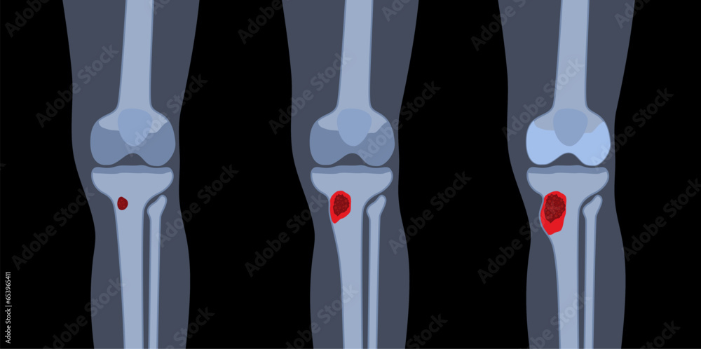 Tibia bone osteomyelitis Tibia bone osteomyelitis