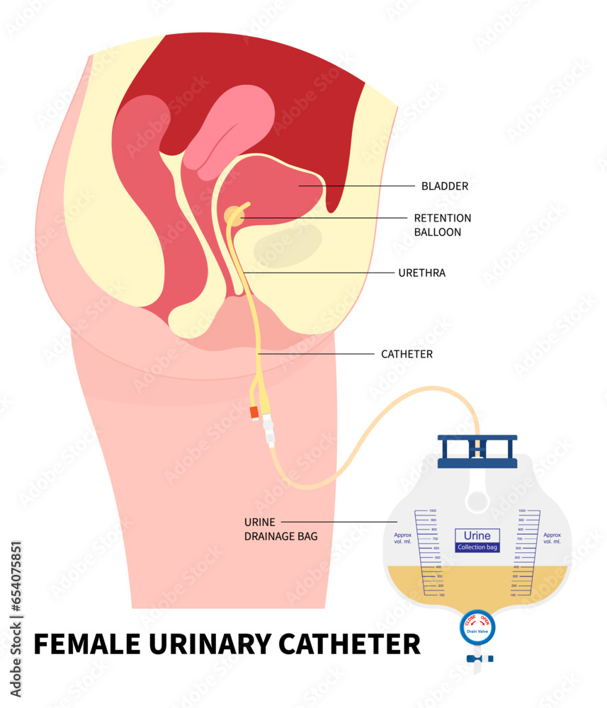 Urinating bag Catheterisation with Urinary Catheter for the E coli