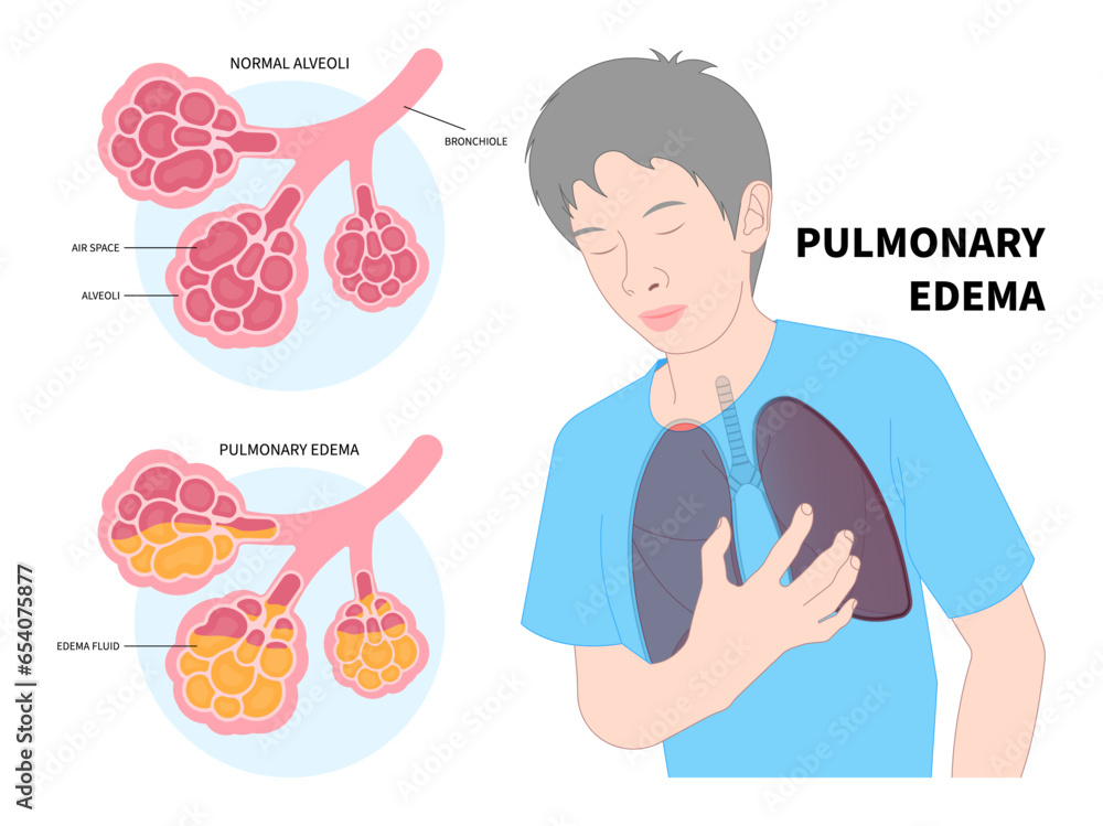 Chest pain shortness of breath oxygen or Pulmonary tract edema with RSV