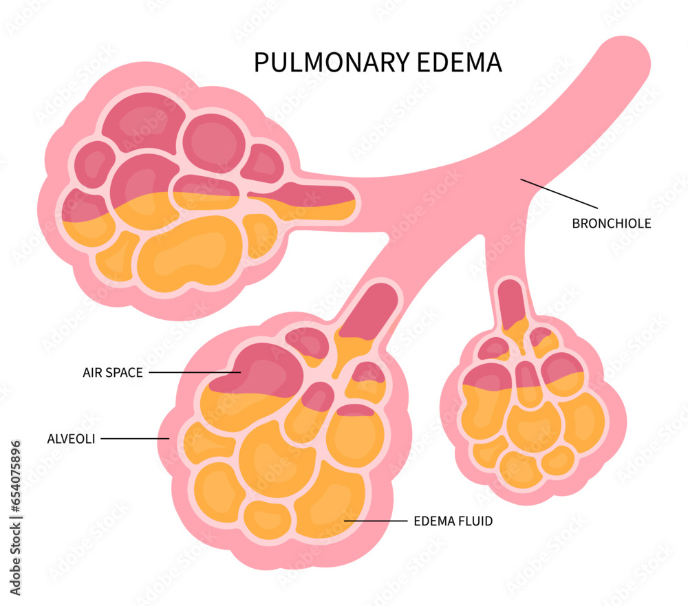 Pulmonary edema with RSV and COPD flu distress virus in Human the