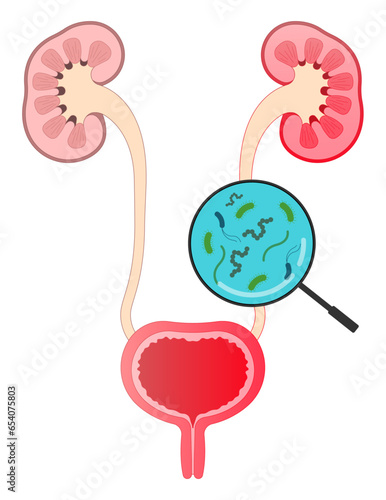 Cause of frequent urge urination or bloody urine pelvic painful in urinary tract with the E coli and C diff fungal germ infection