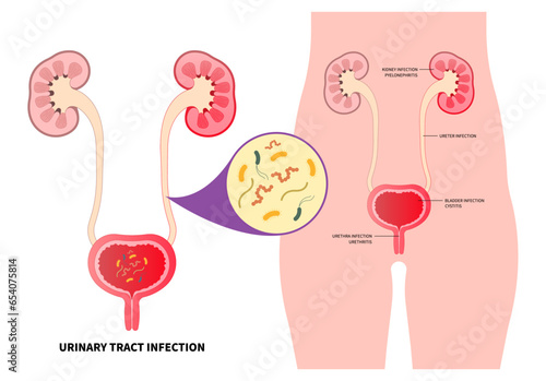 kidney stones of urinary tract infection with the E coli and C diff fungal germ cause frequent urge urination or Bloody urine pelvic painful
