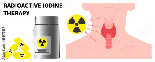 Neck swelling with Radioactive iodine to treat Graves' and Hashimoto's disease
