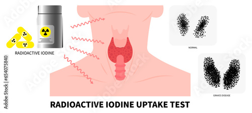 Neck swelling with Radioactive iodine to treat Graves' and Hashimoto's disease