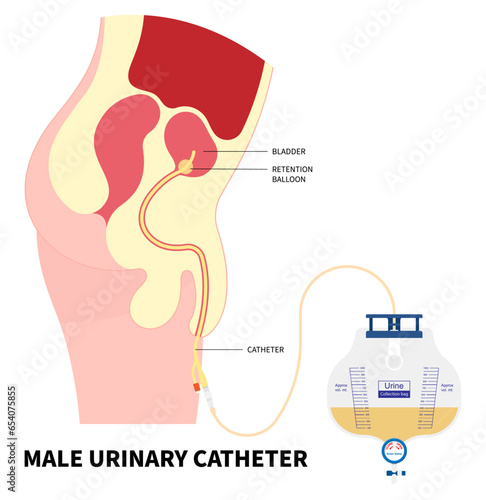 Urology urinary catheters Catheterisation for the E coli bacteria infection of enlarged bladder gland cancer pain with urge leak urinating bag the anatomy medical photo