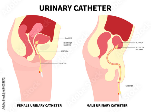 Urinary Catheters for the E coli bacteria infection of bladder with Catheterisation in urology urge leak urinating bag anatomy medical and pain gland or Enlarged cancer photo