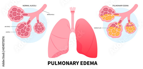 Lung pulmonary cancer common cold with RSV and COPD flu distress virus in Human chest pain the COVID Coronavirus or edema sepsis Xray for oxygen breath tract medical photo