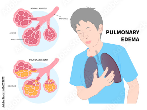 Chest pain shortness of breath oxygen or Pulmonary tract edema with RSV and COPD flu distress virus in Human the common cold COVID Coronavirus cancer sepsis Xray for medical