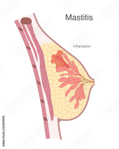Side view of breast internal structure with mammary gland lobe and fat tissue inflammation shown with reddish color. Human medical anatomy illustration.