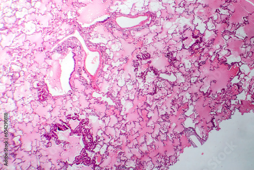 Obraz na płótnie Lung adenocarcinoma, light micrograph