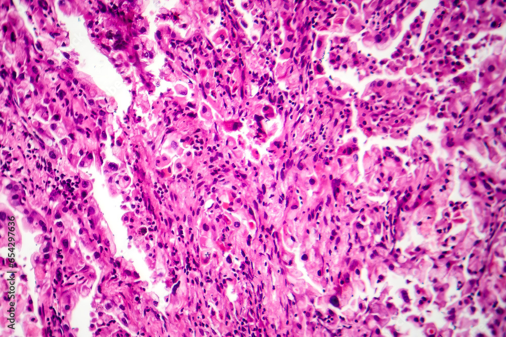 Lung cancer tissue, light micrograph Lung cancer tissue, light micrograph