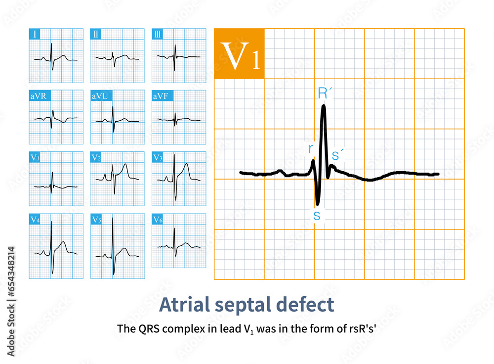 Male, 46 years old, clinically diagnosed with secondary atrial septal ...