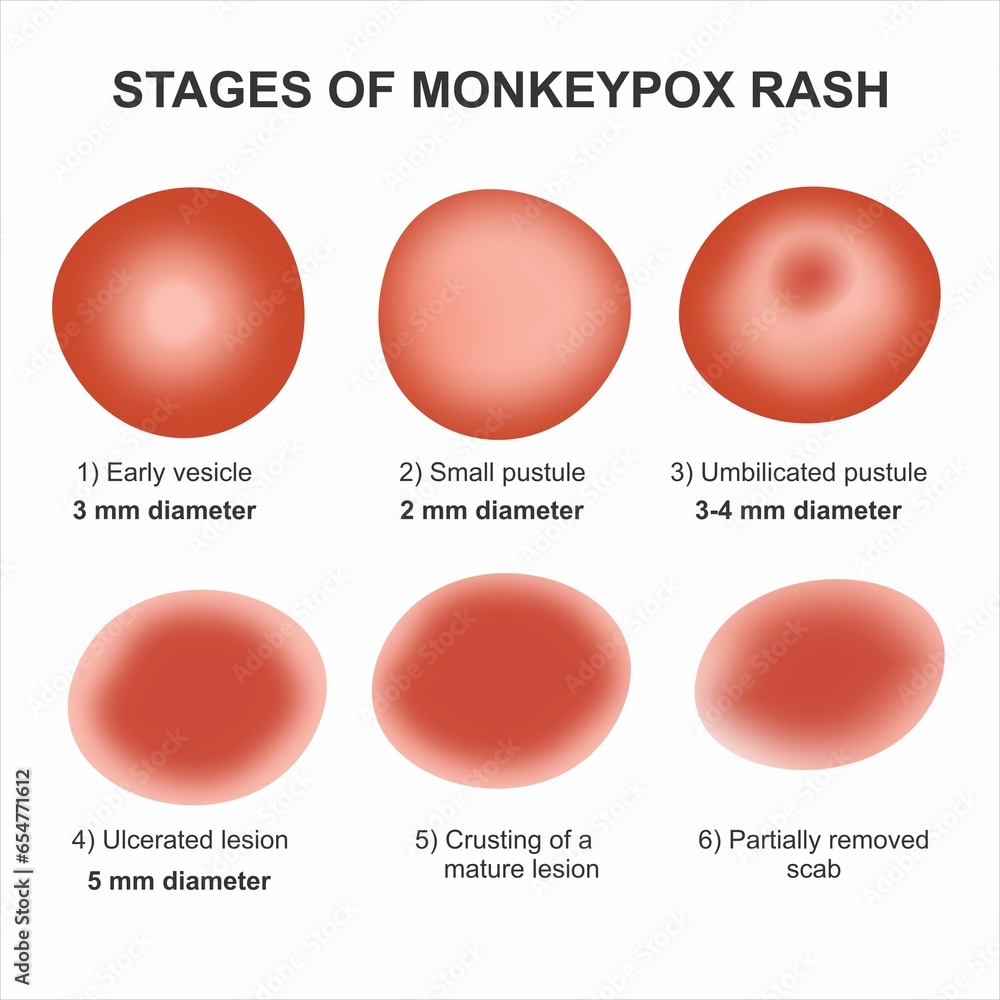 Stages of Monkeypox Rashes illustration Stock Illustration Adobe Stock