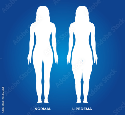 Woman Illustration Silhouette with Normal and Lipedema Legs