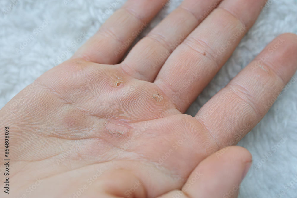 A close-up of the palm of his hand, showing the calluses. Hands blistered from the hard work of being an athlete. A close-up of the palm of his hand, showing the calluses. Hands blistered from the hard work of being an athlete.