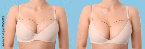 Woman with marks on her chest against white background. Concept of breast augmentation photo