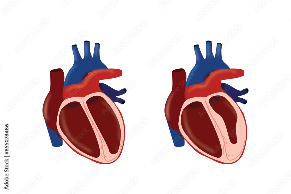 Cardiomyopathy. Healthy heart and heart with enlarged and thickened muscle. cross section of human's heart. eps 10 Cardiomyopathy. Healthy heart and heart with enlarged and thickened muscle. cross section of human's heart. eps 10
