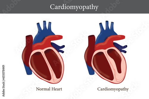 Cardiomyopathy. Healthy heart and heart with enlarged and thickened muscle. cross section of human's heart. eps 10